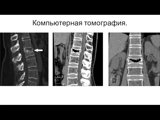 Компьютерная томография.