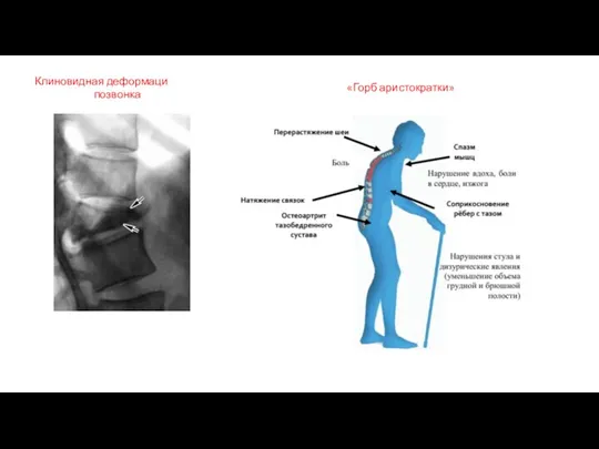 Клиновидная деформация тела позвонка «Горб аристократки»