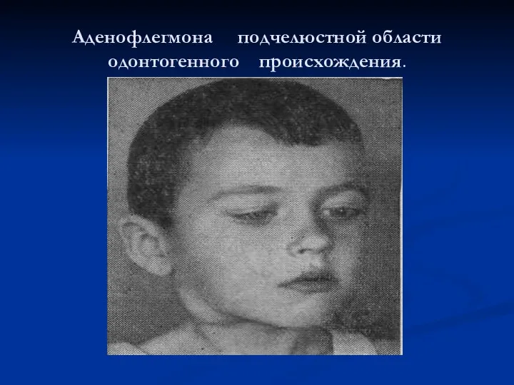 Аденофлегмона подчелюстной области одонтогенного происхождения.