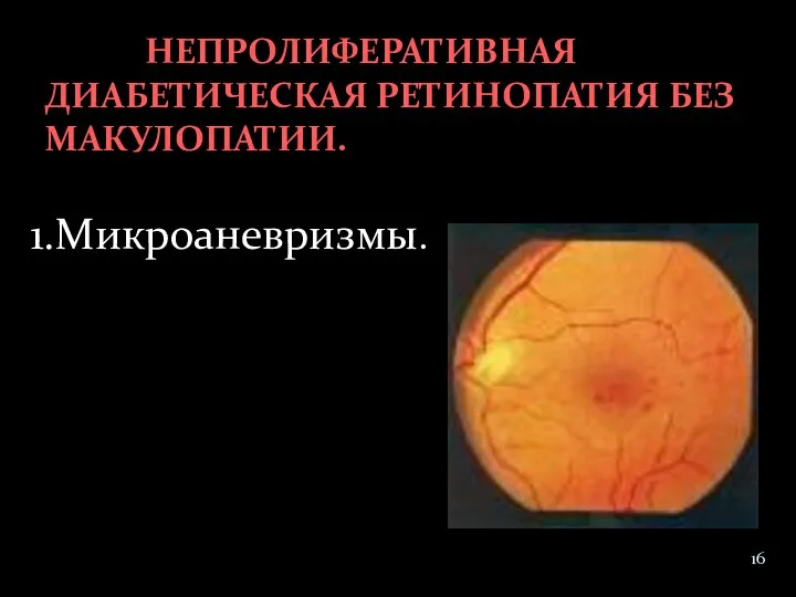 1.Микроаневризмы. НЕПРОЛИФЕРАТИВНАЯ ДИАБЕТИЧЕСКАЯ РЕТИНОПАТИЯ БЕЗ МАКУЛОПАТИИ.