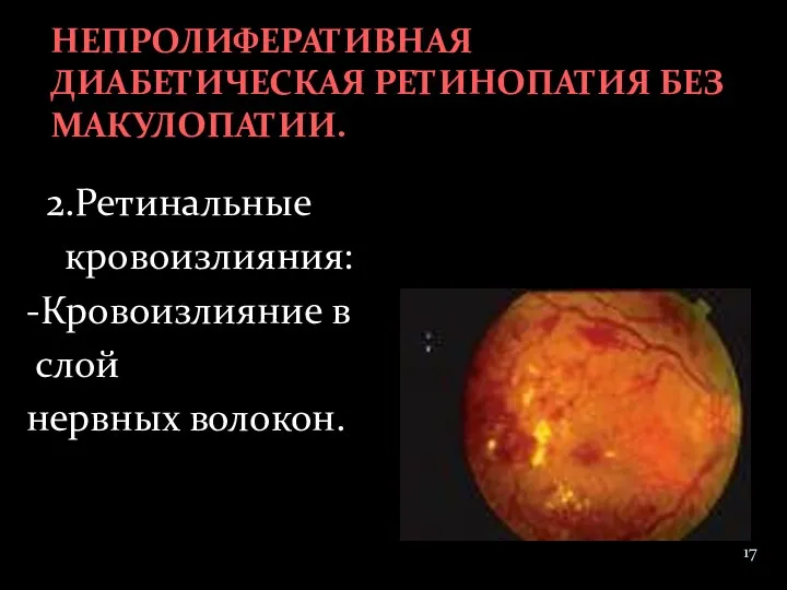 2.Ретинальные кровоизлияния: -Кровоизлияние в слой нервных волокон. НЕПРОЛИФЕРАТИВНАЯ ДИАБЕТИЧЕСКАЯ РЕТИНОПАТИЯ БЕЗ МАКУЛОПАТИИ.