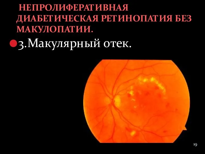 3.Макулярный отек. НЕПРОЛИФЕРАТИВНАЯ ДИАБЕТИЧЕСКАЯ РЕТИНОПАТИЯ БЕЗ МАКУЛОПАТИИ.