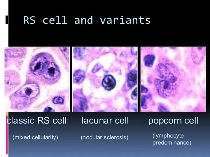 RS cell and variants popcorn cell lacunar cell classic RS