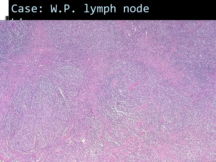 Case: W.P. lymph node biopsy
