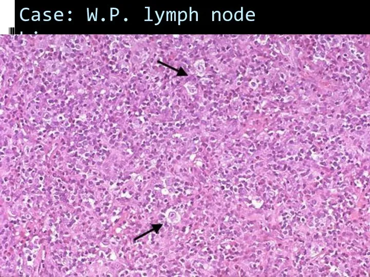 Case: W.P. lymph node biopsy