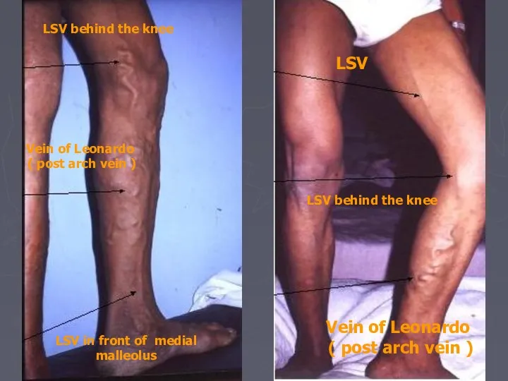 LSV LSV behind the knee Vein of Leonardo ( post
