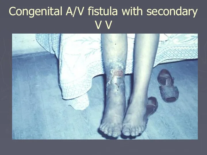 Congenital A/V fistula with secondary V V
