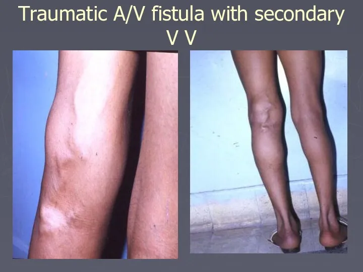 Traumatic A/V fistula with secondary V V