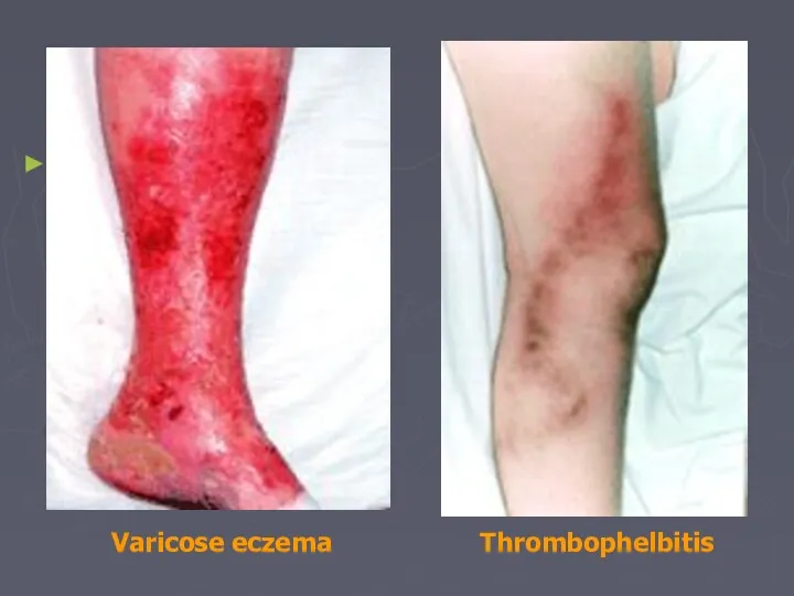 Thrombophelbitis Varicose eczema