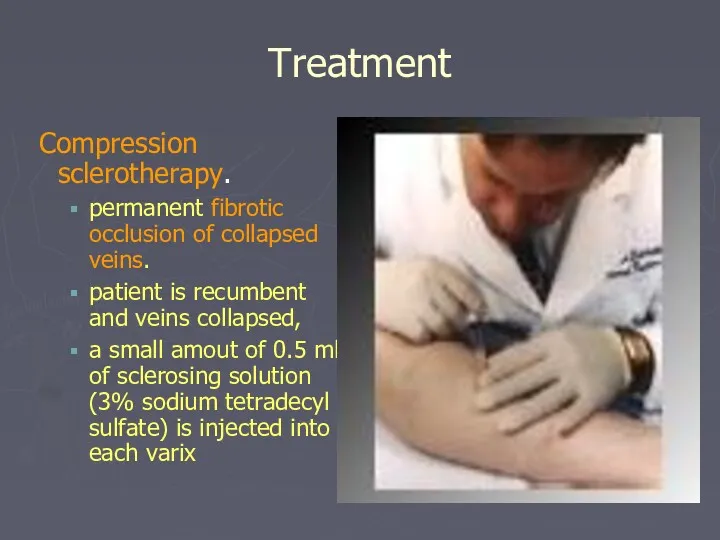 Treatment Compression sclerotherapy. permanent fibrotic occlusion of collapsed veins. patient
