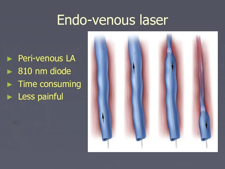 Endo-venous laser Peri-venous LA 810 nm diode Time consuming Less painful