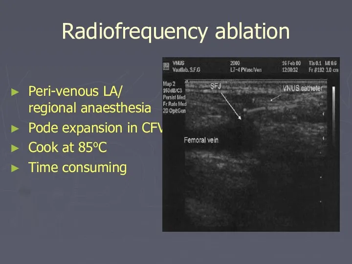 Radiofrequency ablation Peri-venous LA/ regional anaesthesia Pode expansion in CFV Cook at 85oC Time consuming
