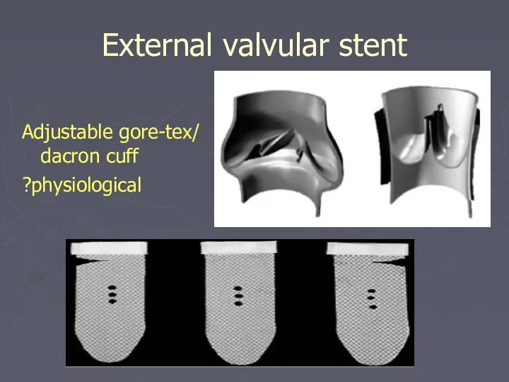 External valvular stent Adjustable gore-tex/ dacron cuff ?physiological