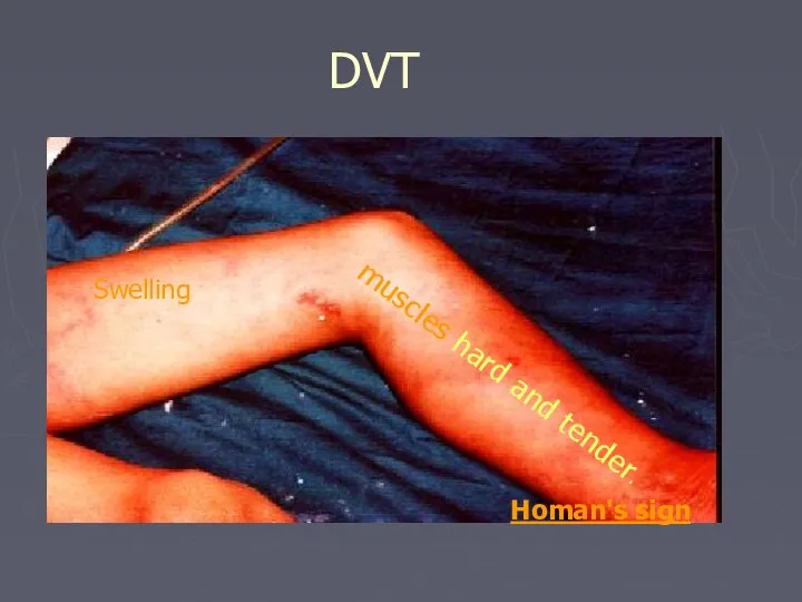DVT Swelling muscles hard and tender. Homan's sign