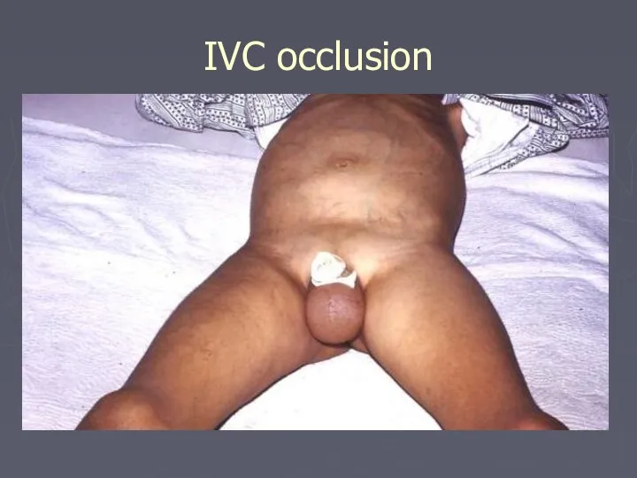 IVC occlusion
