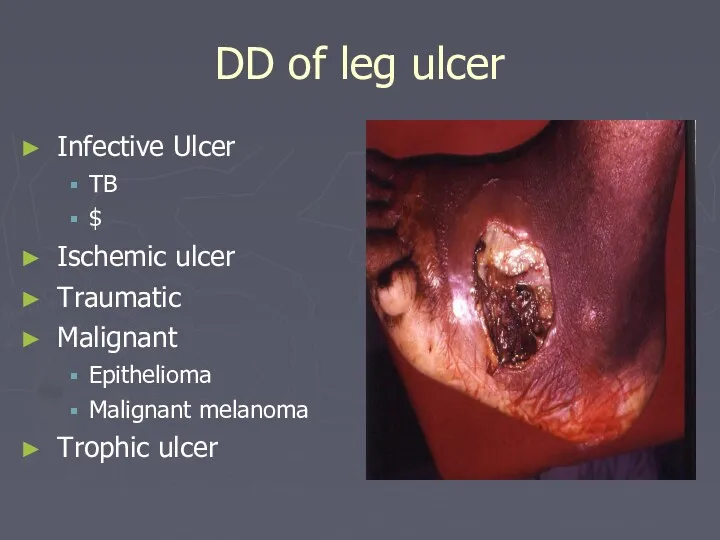 DD of leg ulcer Infective Ulcer TB $ Ischemic ulcer