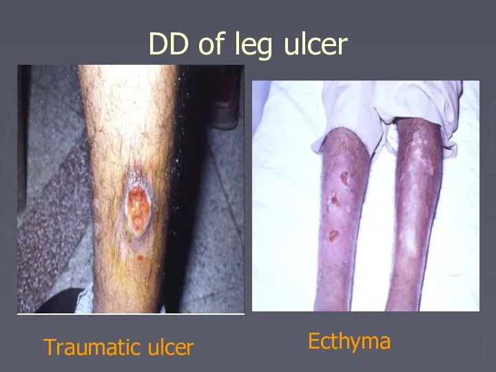 DD of leg ulcer Traumatic ulcer Ecthyma