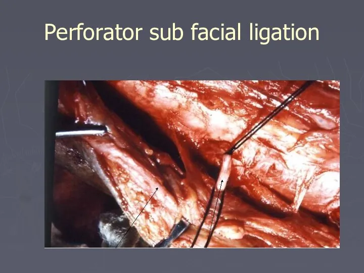 Perforator sub facial ligation