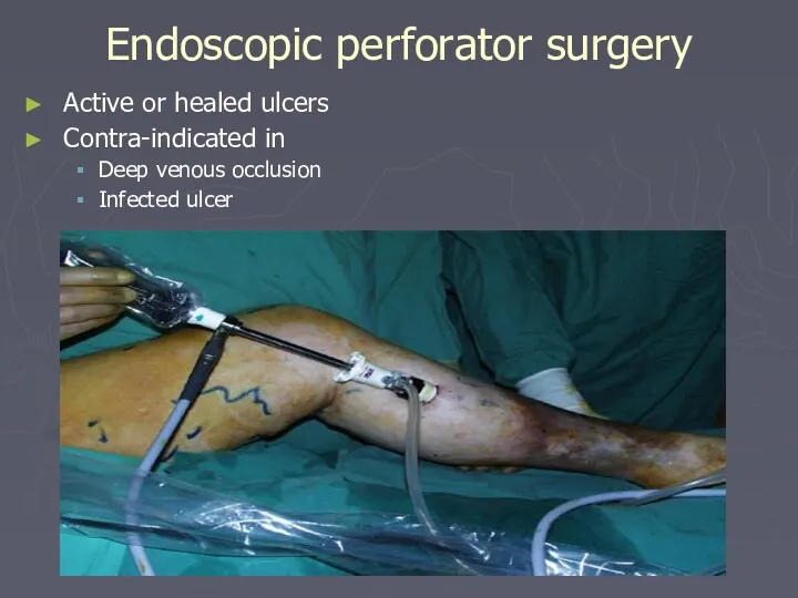 Endoscopic perforator surgery Active or healed ulcers Contra-indicated in Deep venous occlusion Infected ulcer