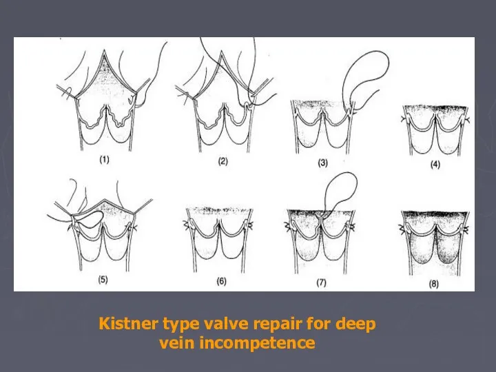 Kistner type valve repair for deep vein incompetence