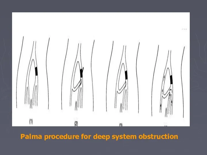 Palma procedure for deep system obstruction