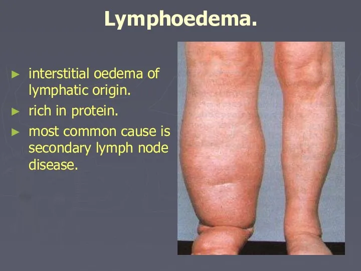 Lymphoedema. interstitial oedema of lymphatic origin. rich in protein. most