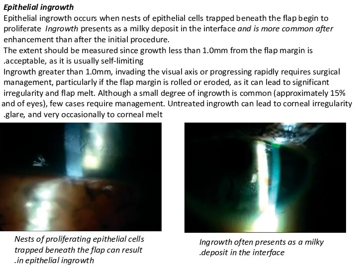 Epithelial ingrowth Epithelial ingrowth occurs when nests of epithelial cells