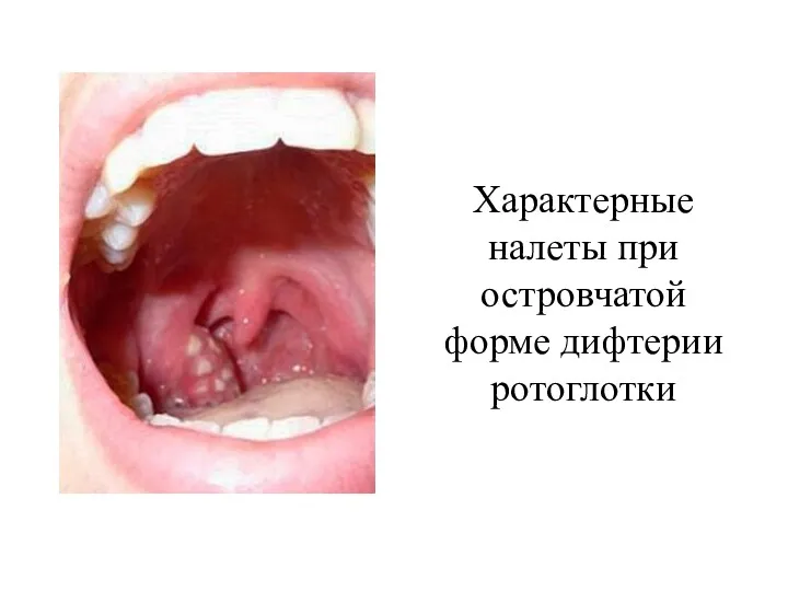 Характерные налеты при островчатой форме дифтерии ротоглотки