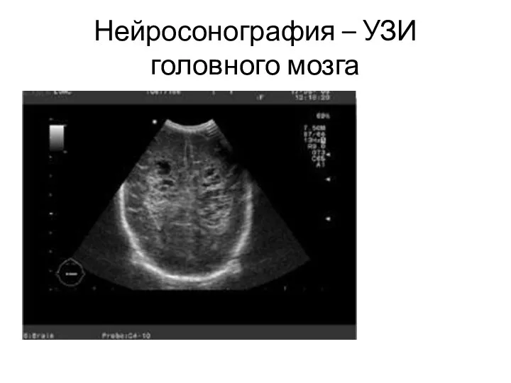 Нейросонография – УЗИ головного мозга