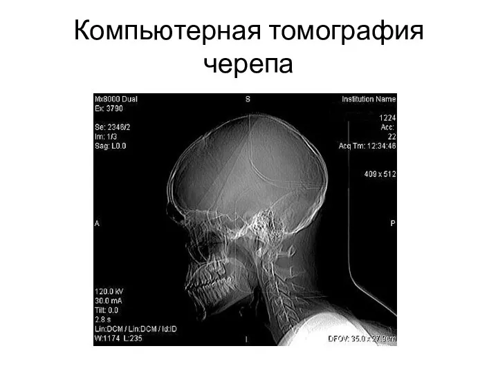 Компьютерная томография черепа