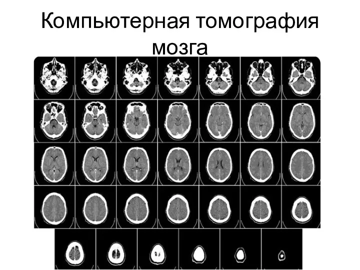 Компьютерная томография мозга