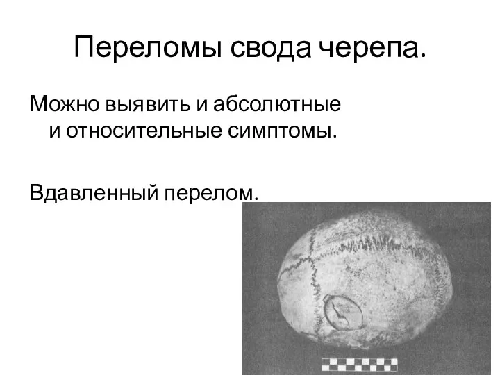 Переломы свода черепа. Можно выявить и абсолютные и относительные симптомы. Вдавленный перелом.