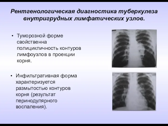 Рентгенологическая диагностика туберкулеза внутригрудных лимфатических узлов. Инфильтративная форма характеризуется размытостью