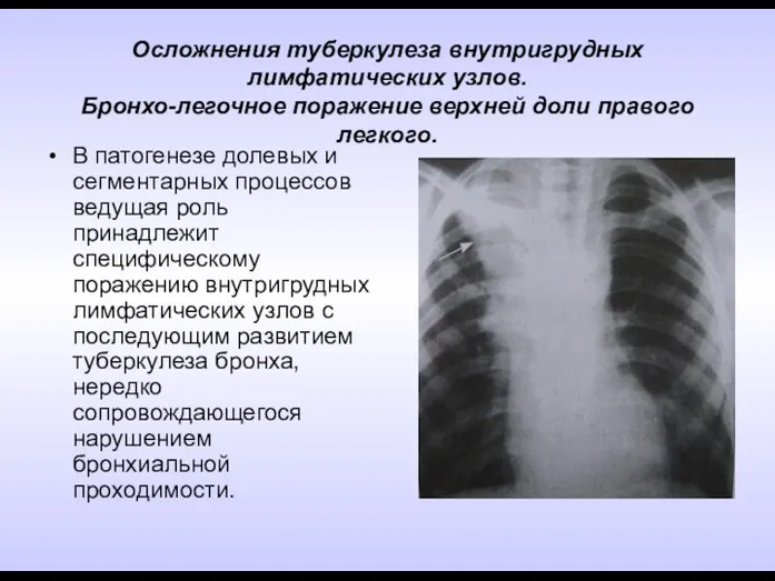 Осложнения туберкулеза внутригрудных лимфатических узлов. Бронхо-легочное поражение верхней доли правого