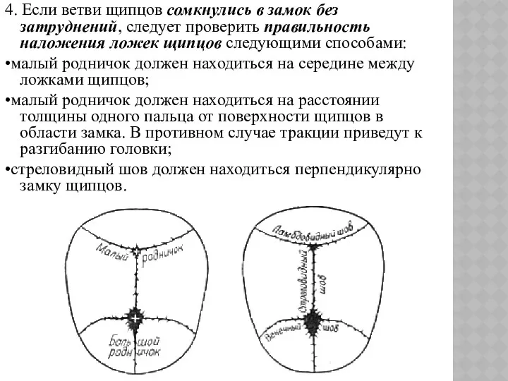 4. Если ветви щипцов сомкнулись в замок без затруднений, следует