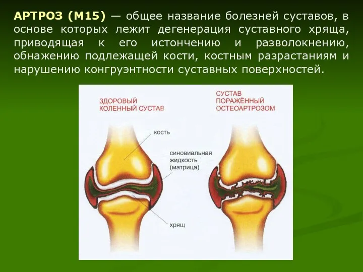 АРТРОЗ (М15) — общее название болезней суставов, в основе которых