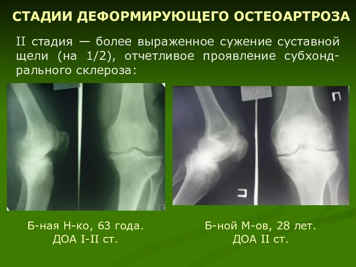 II стадия — более выраженное сужение суставной щели (на 1/2),