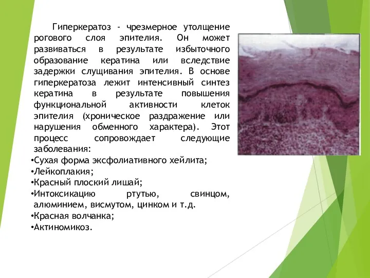 Гиперкератоз - чрезмерное утолщение рогового слоя эпителия. Он может развиваться