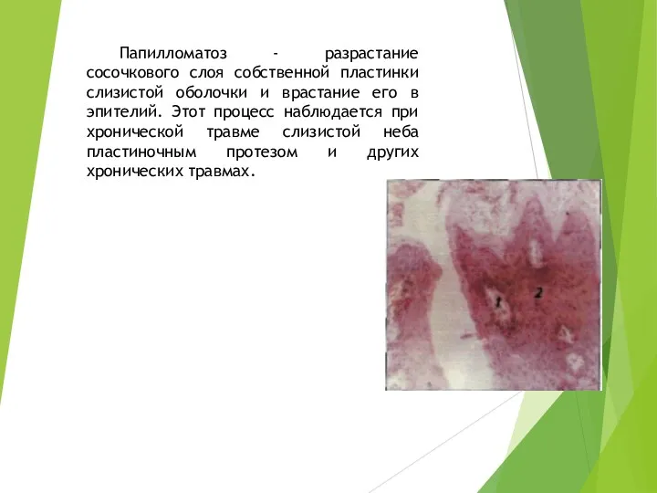 Папилломатоз - разрастание сосочкового слоя собственной пластинки слизистой оболочки и