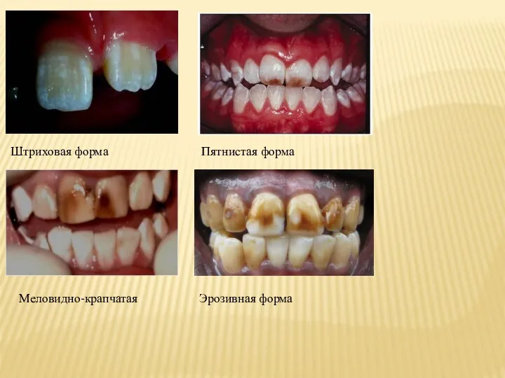 Штриховая форма Пятнистая форма Меловидно-крапчатая Эрозивная форма