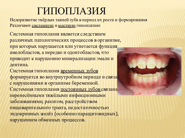 ГИПОПЛАЗИЯ Недоразвитие твёрдых тканей зуба в период их роста и формирования Различают системную