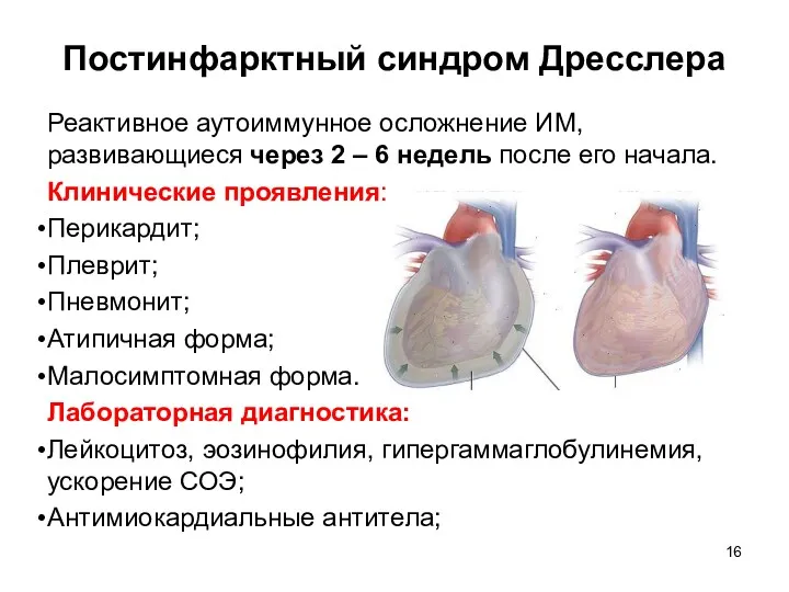 Постинфарктный синдром Дресслера Реактивное аутоиммунное осложнение ИМ, развивающиеся через 2