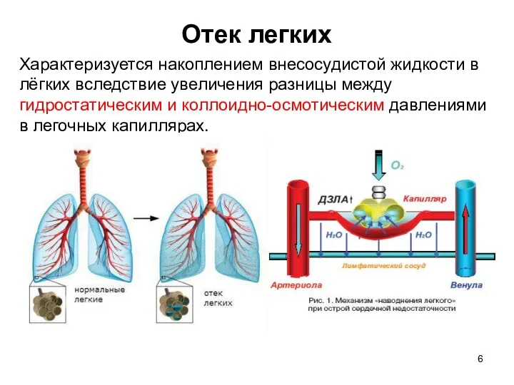 Отек легких Характеризуется накоплением внесосудистой жидкости в лёгких вследствие увеличения