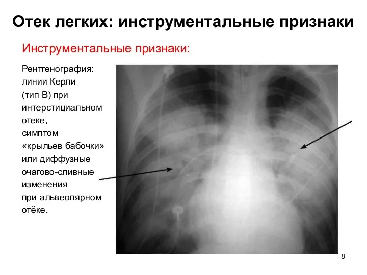 Отек легких: инструментальные признаки Инструментальные признаки: Рентгенография: линии Керли (тип