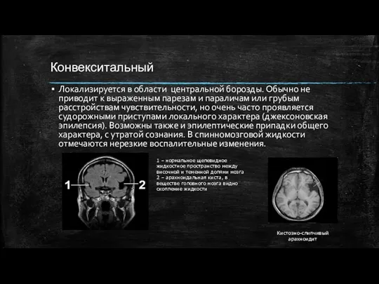 Конвекситальный Локализируется в области центральной борозды. Обычно не приводит к