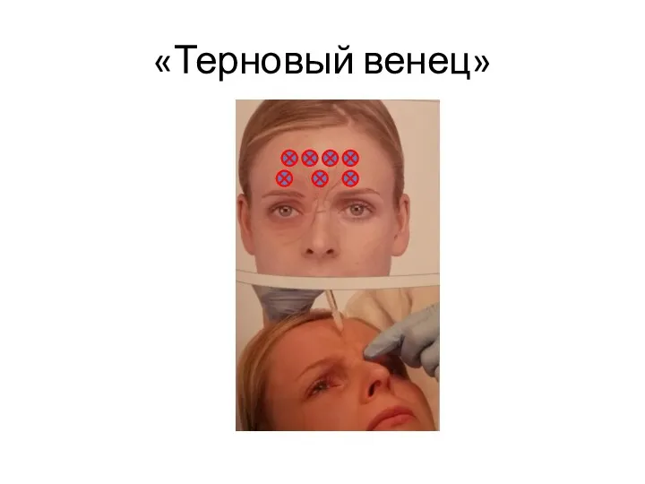 «Терновый венец»