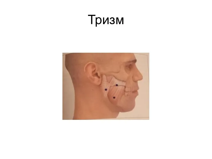 Тризм