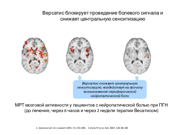 Версатис блокирует проведение болевого сигнала и снижает центральную сенситизацию МРТ мозговой активности у