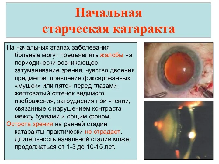 Начальная старческая катаракта На начальных этапах заболевания больные могут предъявлять