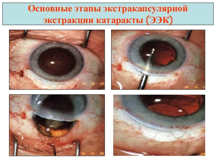 Основные этапы экстракапсулярной экстракции катаракты (ЭЭК)